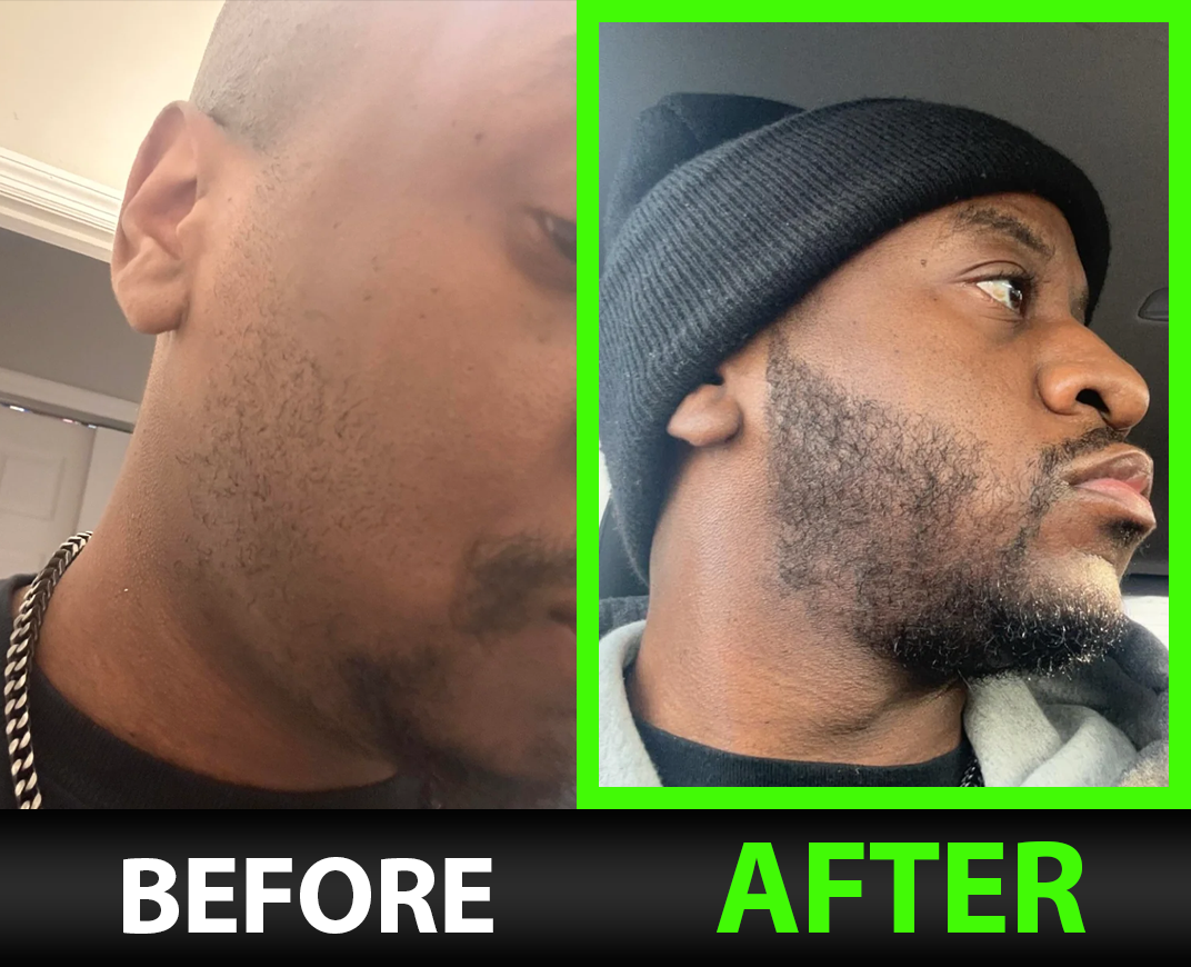 BBS Beard Growth Serum with Minoxidil, 2X Biotin, Rice Water, and LCLT