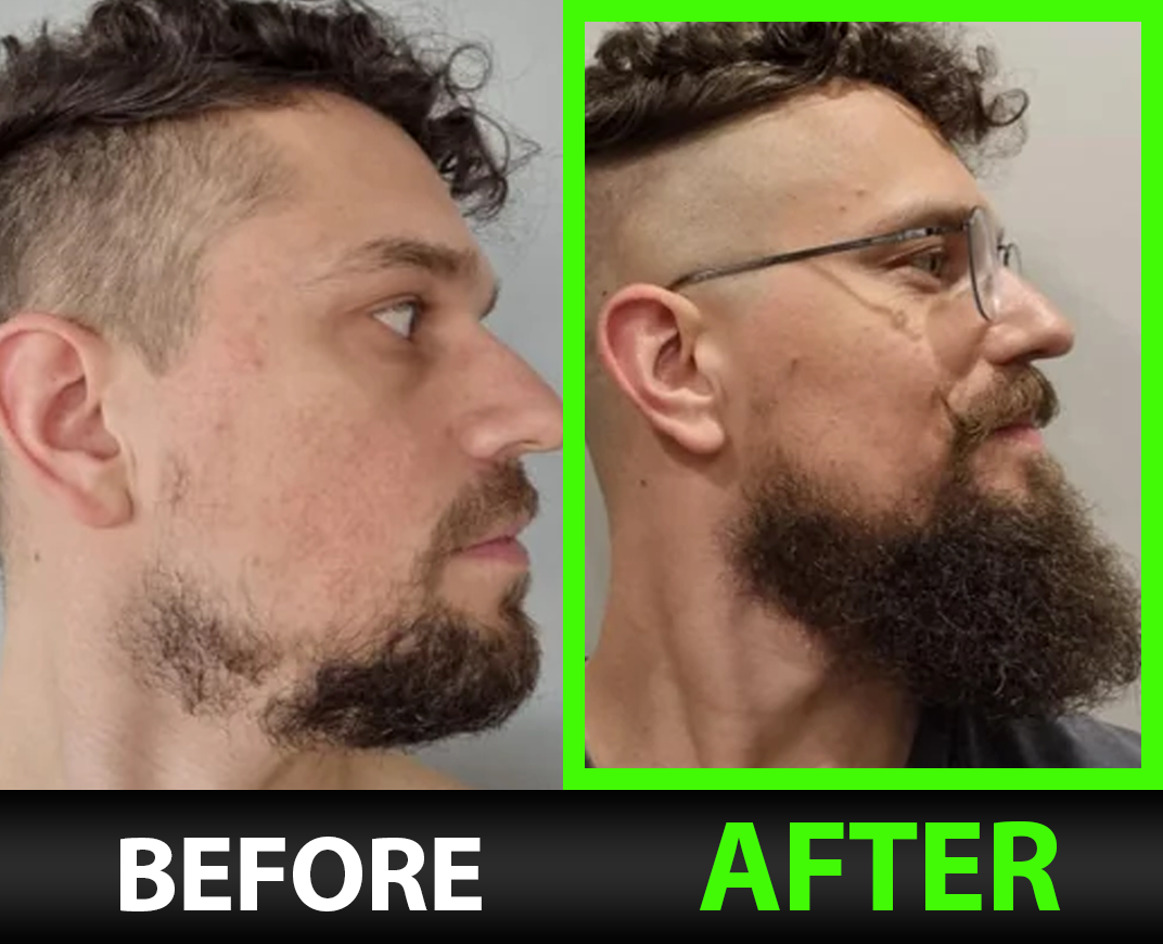 BBS Beard Growth Serum with Minoxidil, 2X Biotin, Rice Water, and LCLT