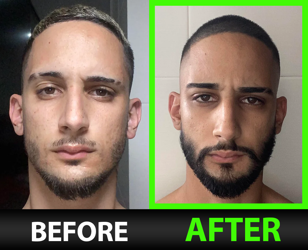 BBS Beard Growth Serum with Minoxidil, 2X Biotin, Rice Water, and LCLT