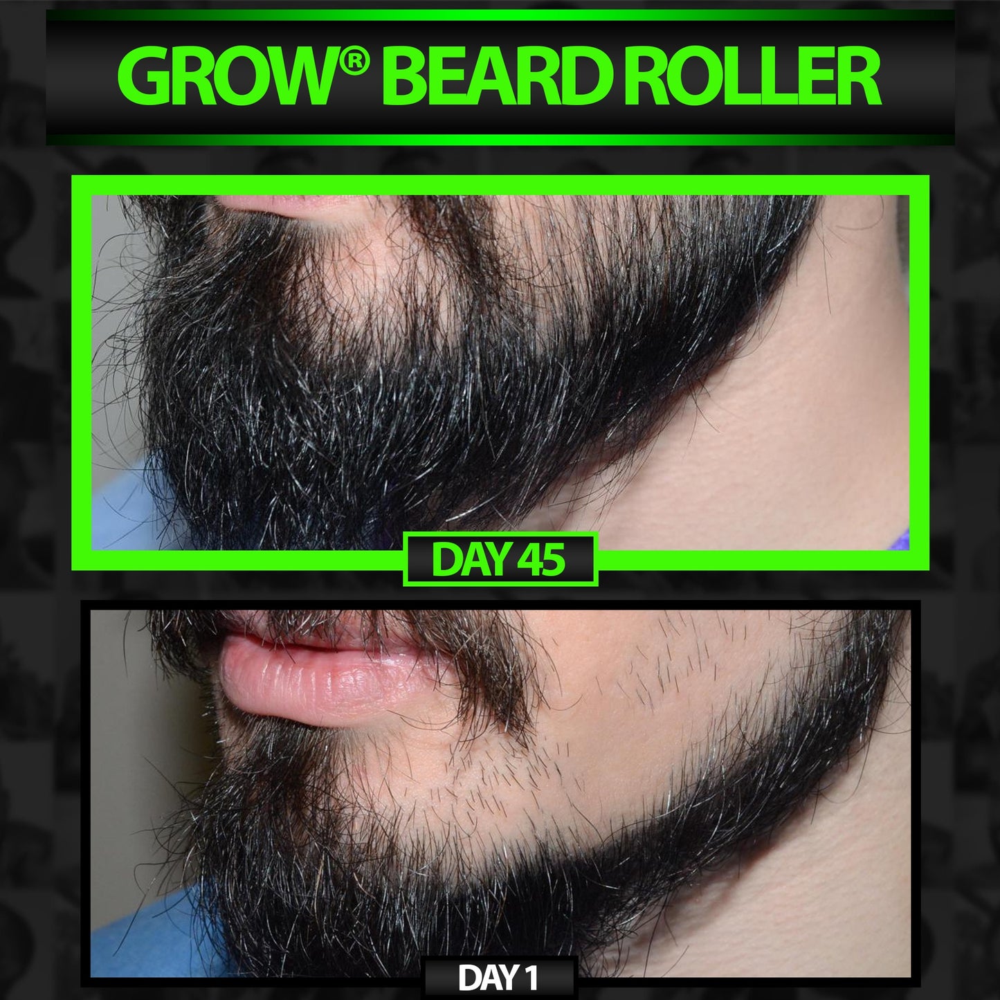GROW® Beard Roller Kit